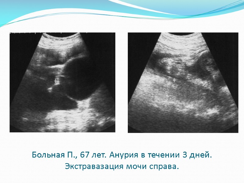 Больная П., 67 лет. Анурия в течении 3 дней. Экстравазация мочи справа.